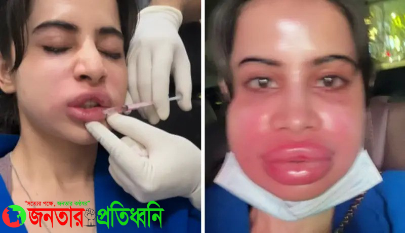 ঠোঁট ফুলে ঢোল, যন্ত্রণায় কাঁদছেন উর্ফী! উদ্বিগ্ন অনুরাগীরা